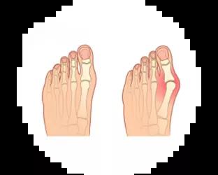 Hallux valgus Fuß